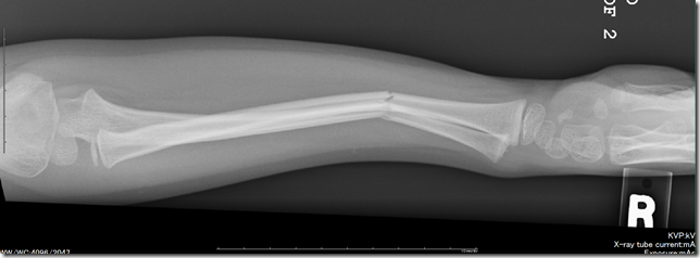 Broken Arm Broken Arm
